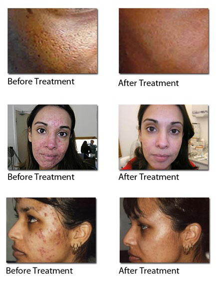 acne regenlite treatment